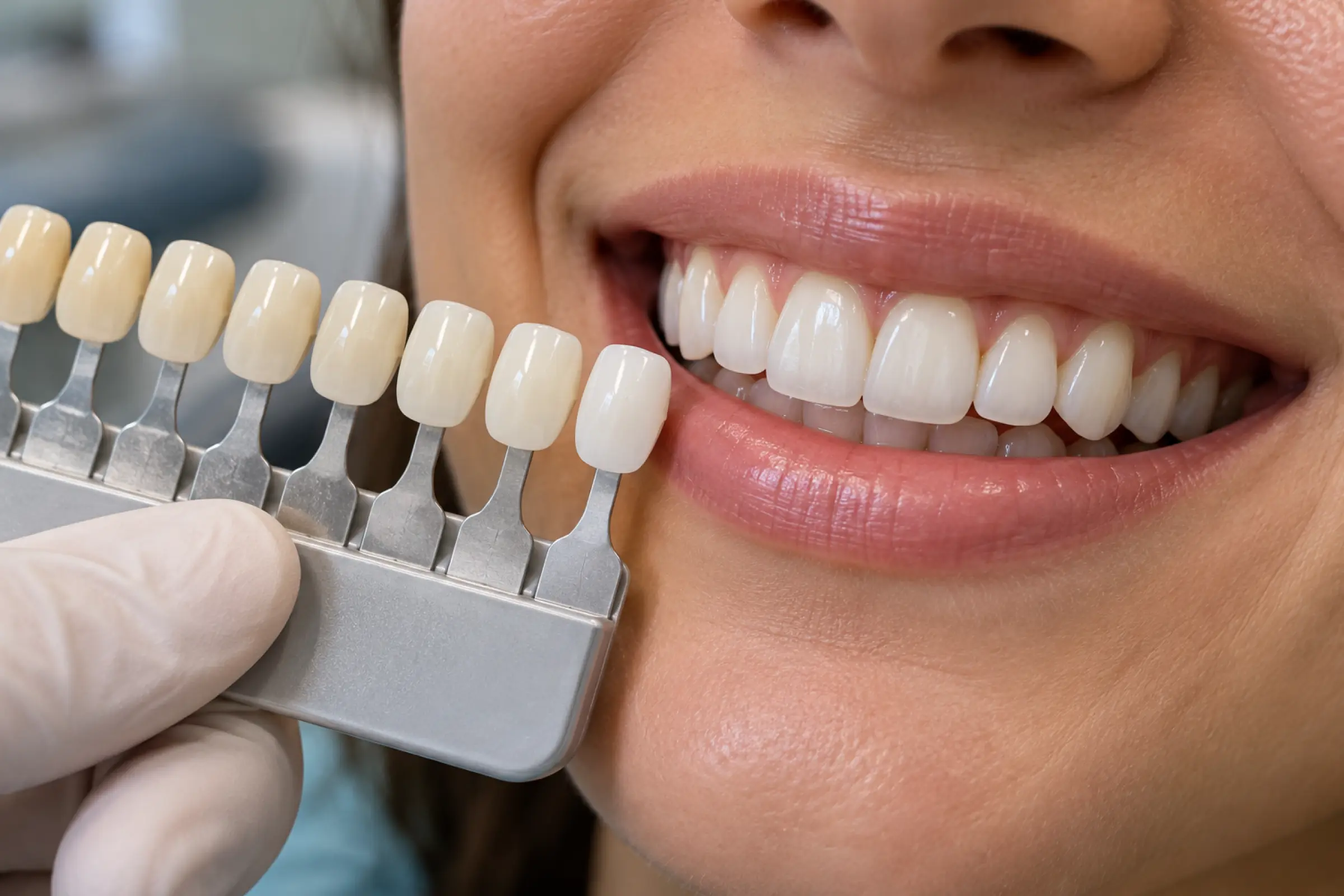 Clareamento dental